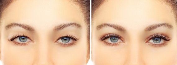 upper-eyelid-surgery-fort-myers-570x211