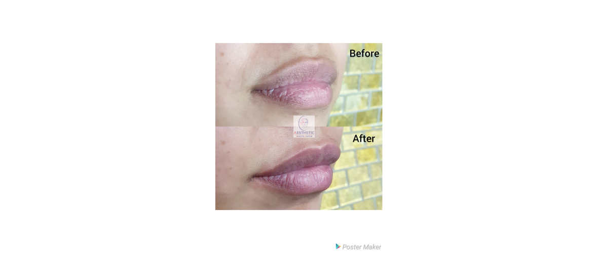 fillers-lippen-10-aesthetic-beautycenter.png