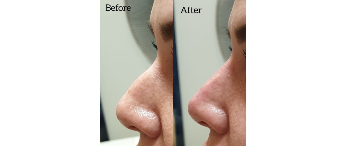 voor en na neusfillers (45).jpeg