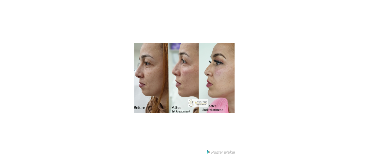 fillers-liquid-facelift-6-aesthetic-beautycenter.png