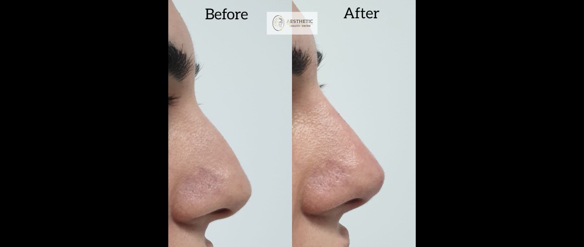 voor en na neusfillers (34).jpeg