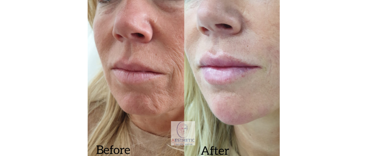 fillers-liquid-facelift-3-aesthetic-beautycenter.png