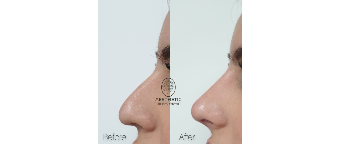 voor en na neusfillers (7).jpeg
