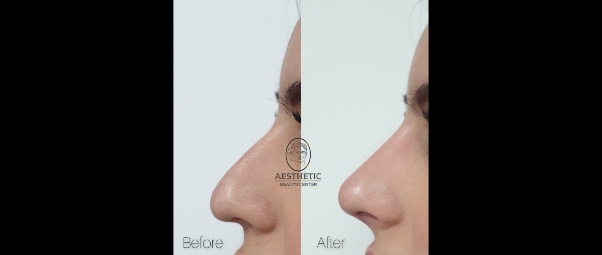 voor en na neusfillers (7).jpeg