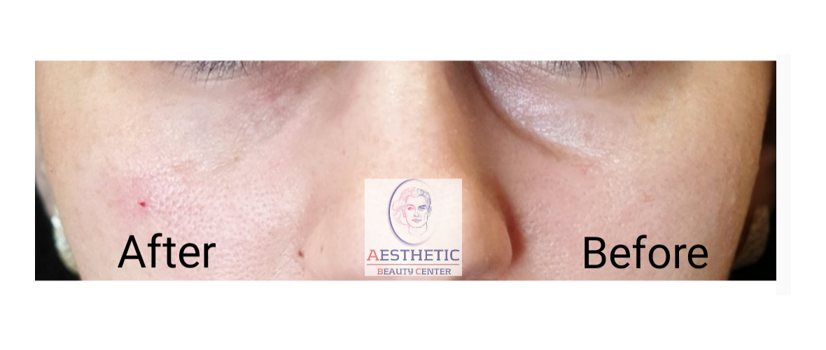 fillers-traangoot-5-aesthetic-beautycenter.png