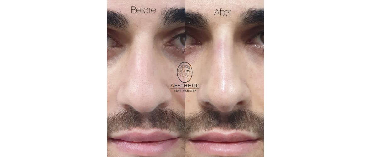 voor en na neusfillers (8).jpeg