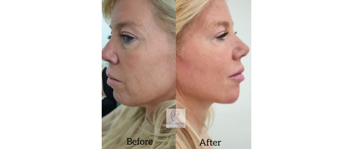fillers-liquid-facelift-2-aesthetic-beautycenter.png