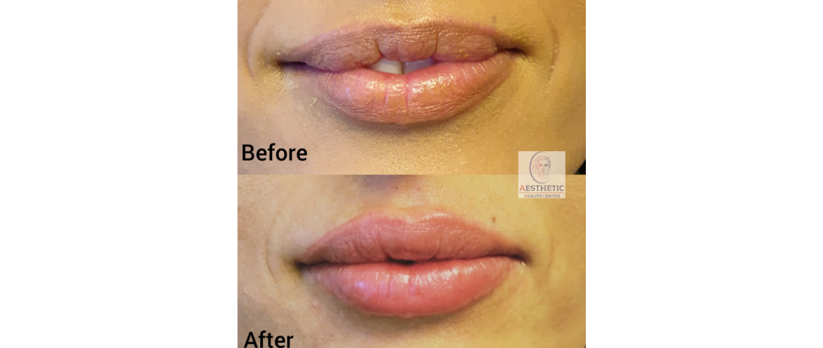 fillers-lippen-4-aesthetic-beautycenter.png