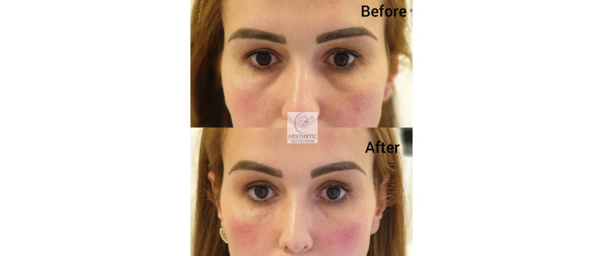 fillers-traangoot-3-aesthetic-beautycenter.png