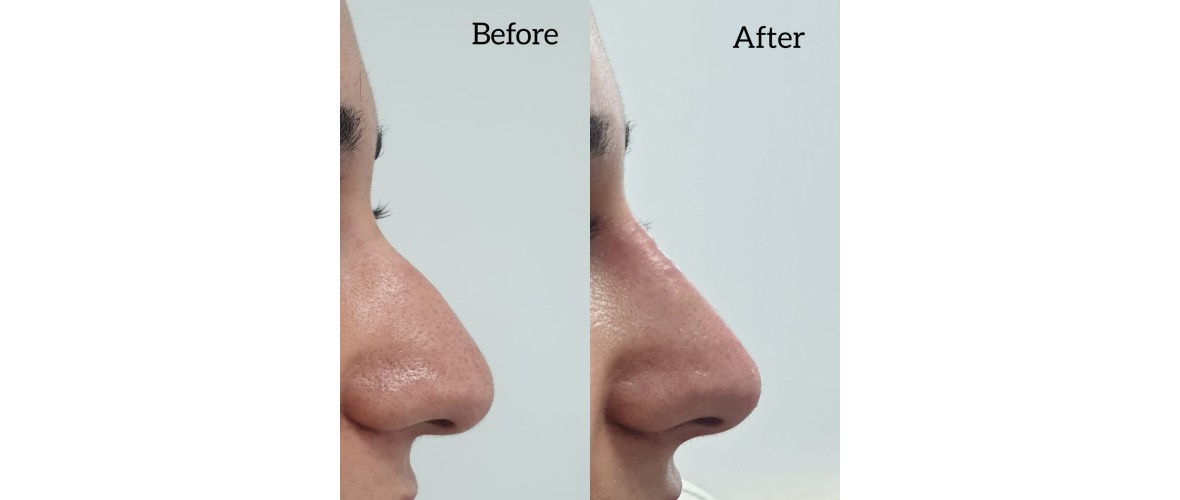 voor en na neusfillers (33).jpeg