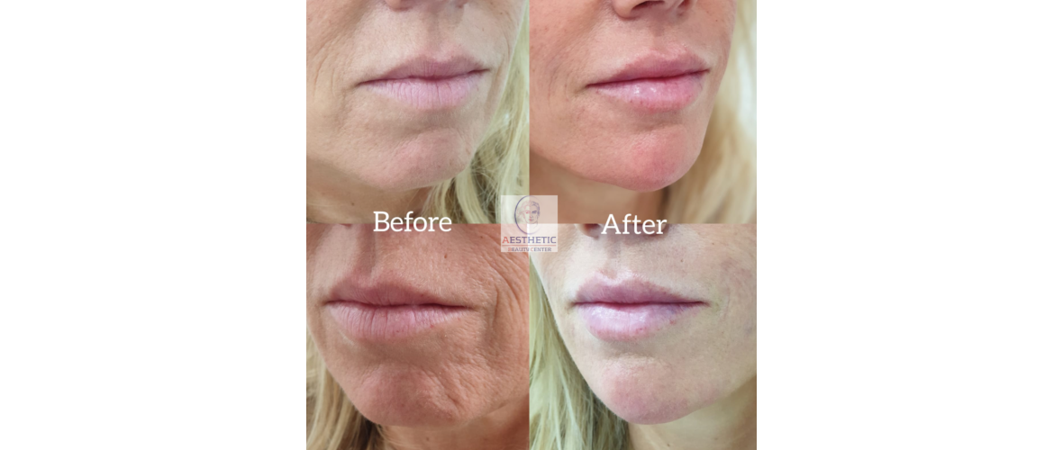 fillers-liquid-facelift-4-aesthetic-beautycenter.png