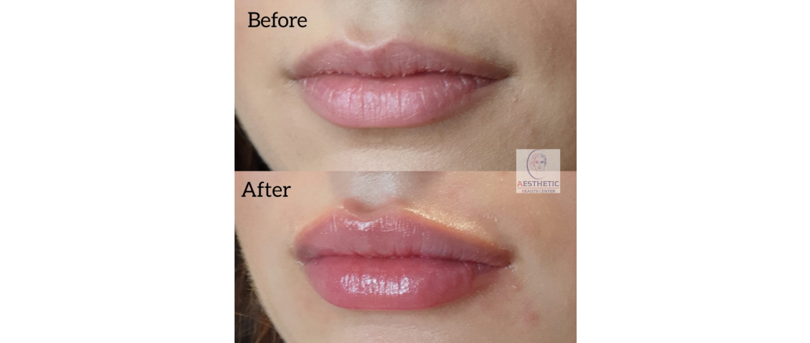 fillers-lippen-5-aesthetic-beautycenter.png