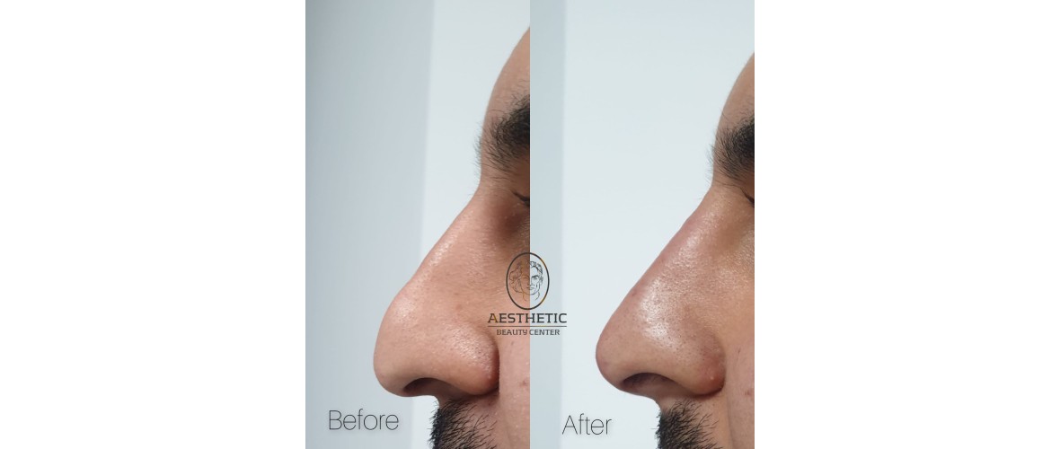 voor en na neusfillers (15).jpeg