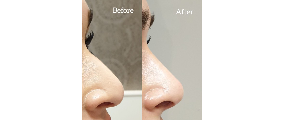 voor en na neusfillers (39).jpeg