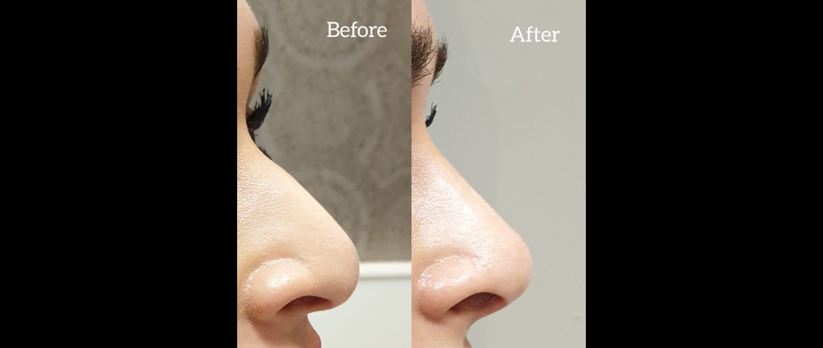 voor en na neusfillers (39).jpeg