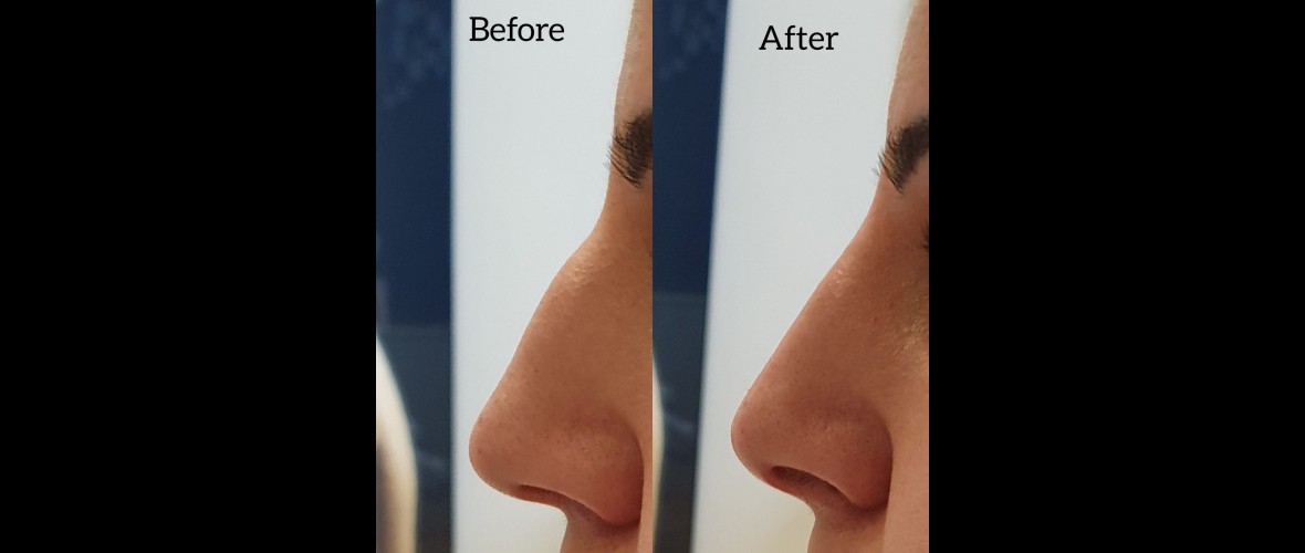 voor en na neusfillers (48).jpeg
